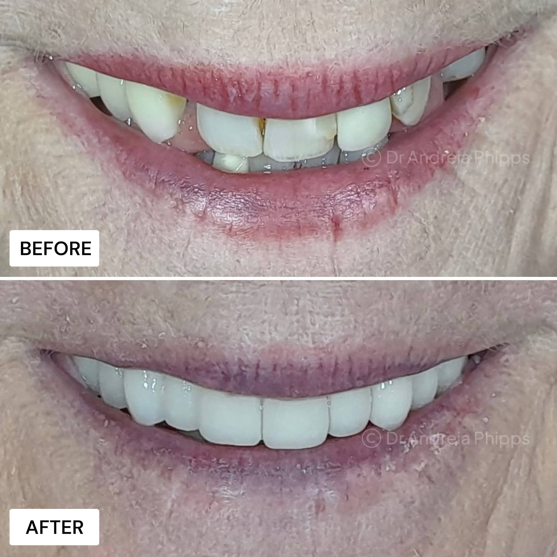 Dental implants London - implant retained dentures patient results