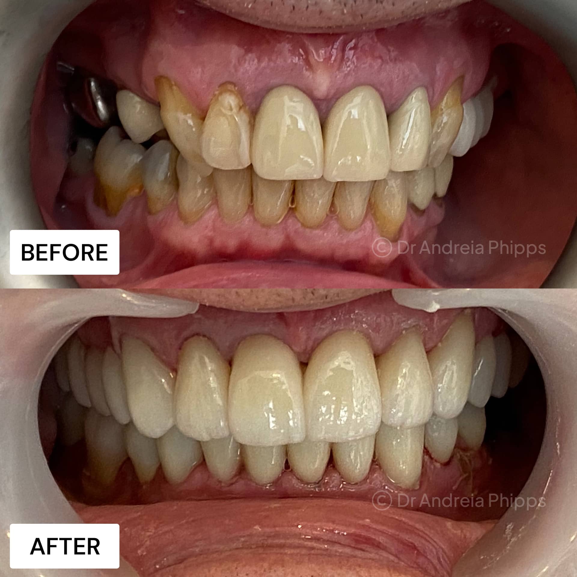 Dental implants London before and after - full mouth rehabilitation at South Kensington clinic