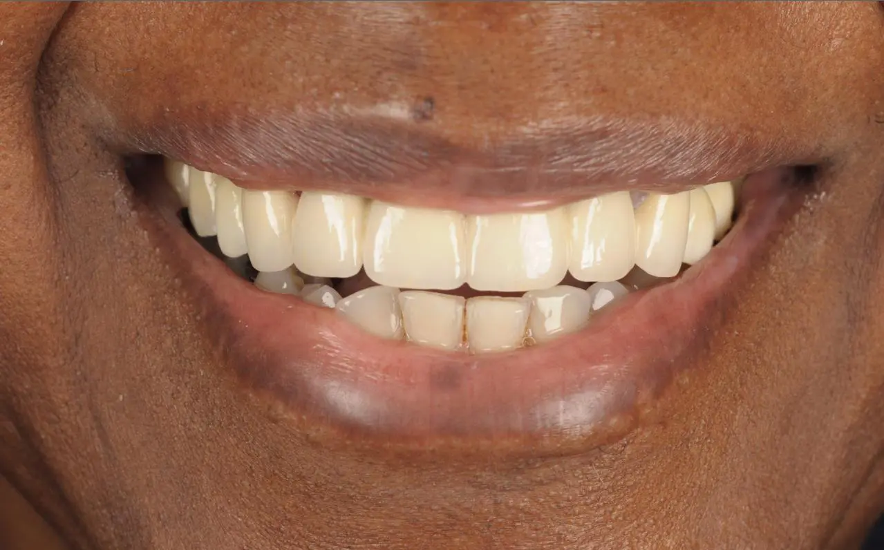 After dental implant procedure