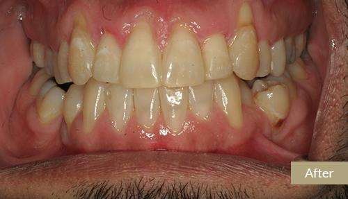 Invisalign Case After 2