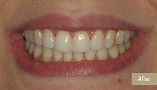 Teeth whitening & bonding after 1