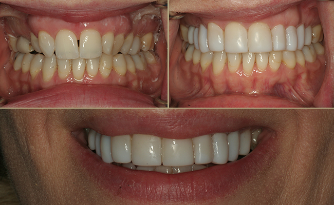 Full upper set of bonding reshaping the smile and face. extremely happy patient
