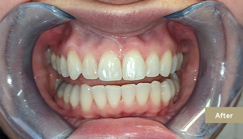 Invisalign Contouring After 2