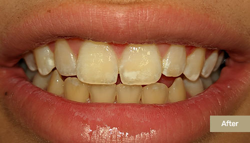 Invisalign Case After 2