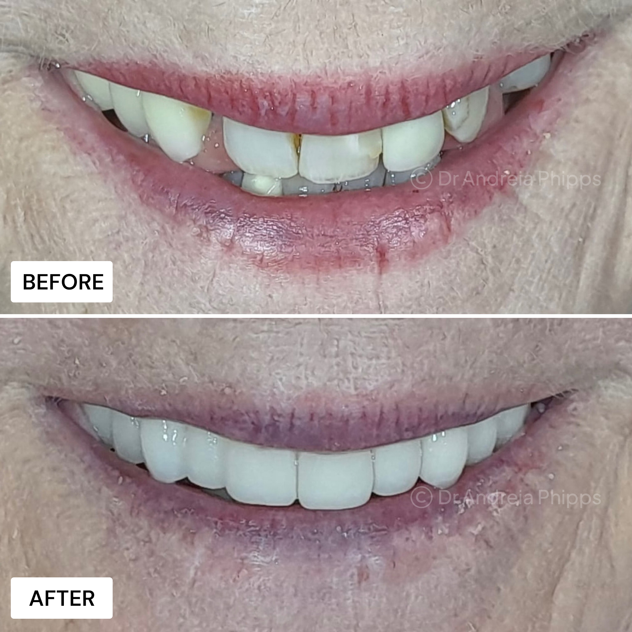 Dental implants London - implant retained dentures patient results