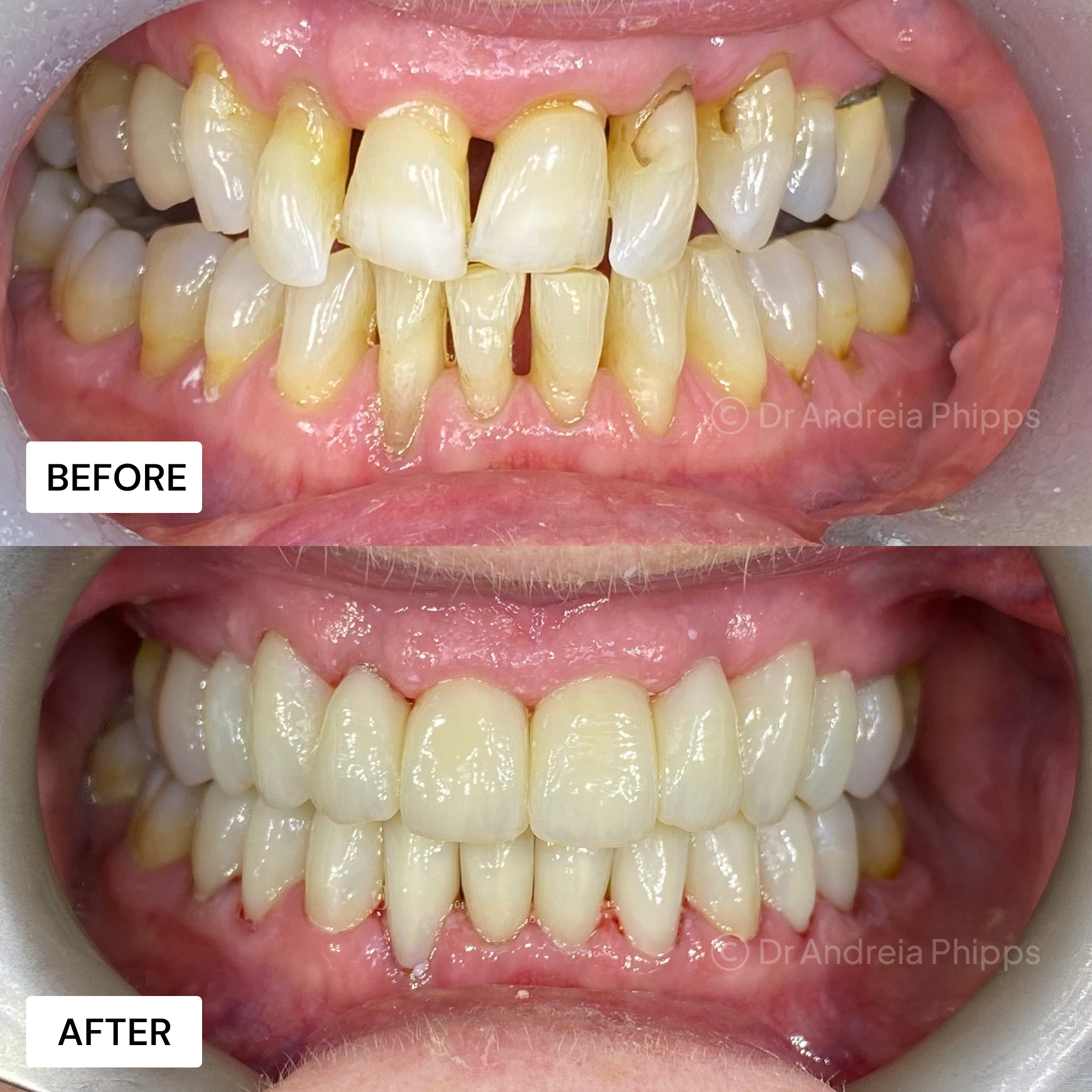 Dental implants London - All-on-4 full arch smile makeover