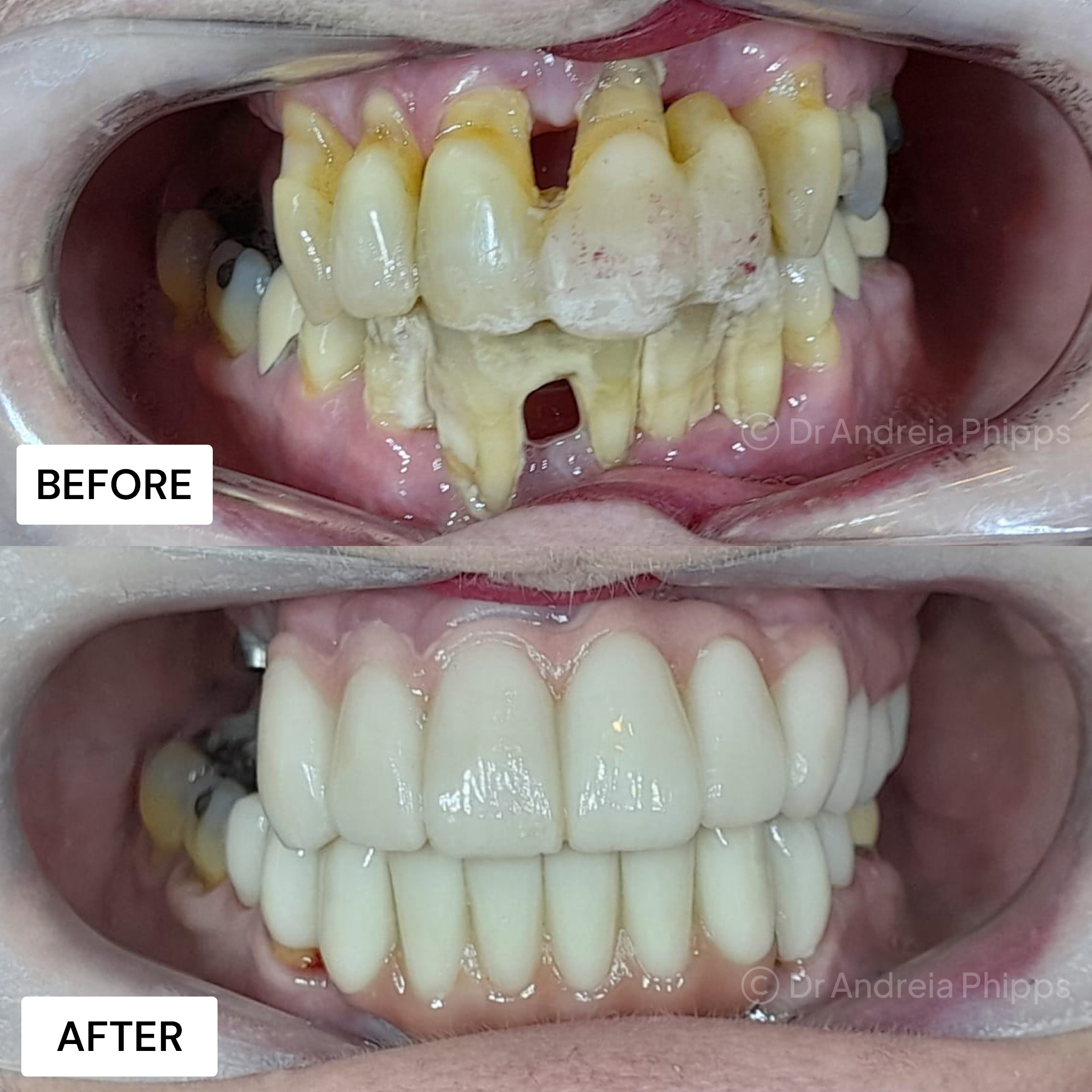 Dental implants London - single tooth implant transformation result