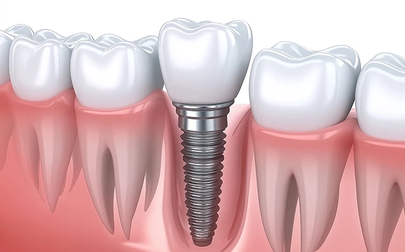 single tooth implant