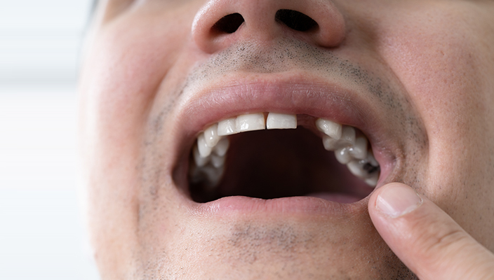 Missing Teeth
