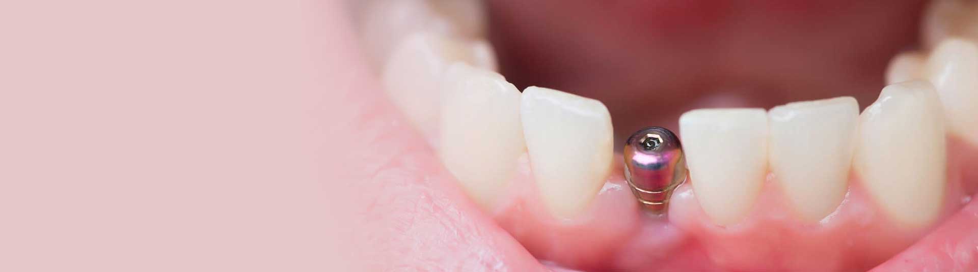 Single Tooth Implant