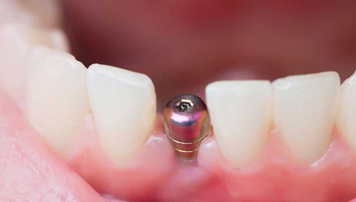 Single Tooth Implant