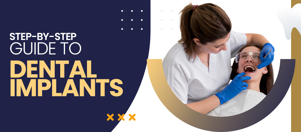 Step-by-Step Guide to Dental Implants