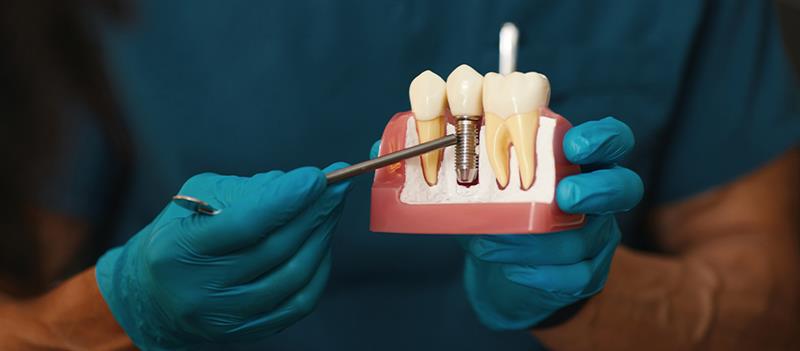 Dental Implants Timeline: From Consultation to Final Smile