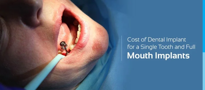 Cost Of Dental Implant For A Single Tooth And Full Mouth Implants