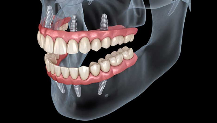 All on 4 & 6 Dental Implants