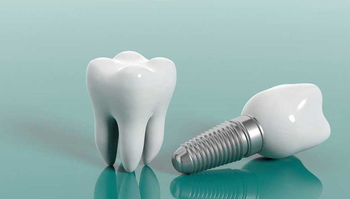 Dental Implants Warranty