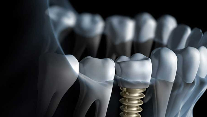 Dental Implants Complications