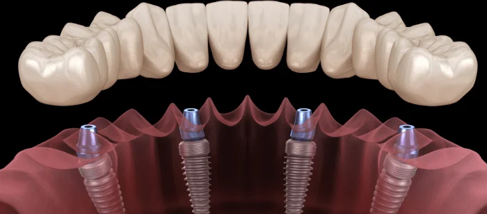 What Can You Expect During All-on-4 Dental Implant Recovery