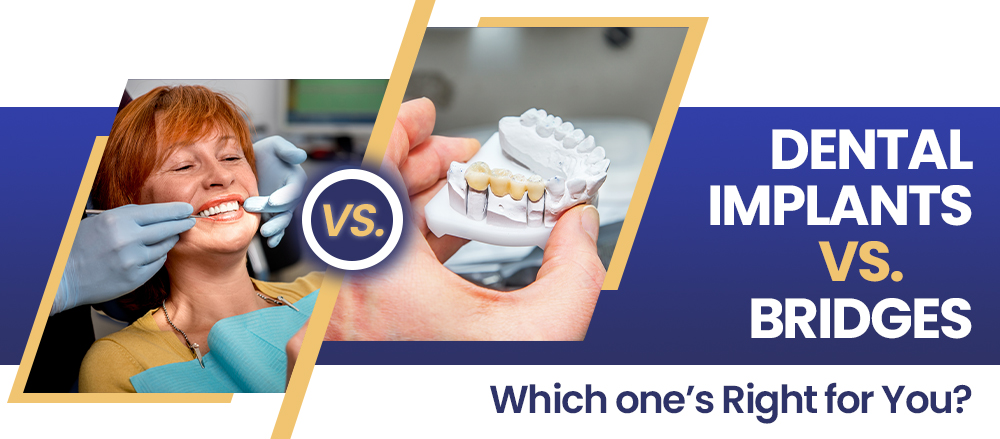 Dental Implants vs. Bridges: Which one’s Right for You?