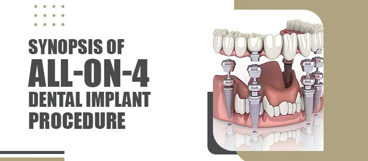 Synopsis of All-on-4 Dental Implant Procedure